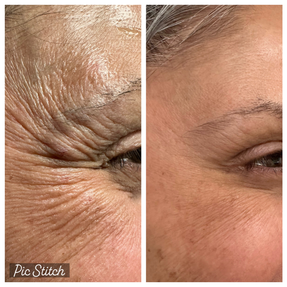 Crows Feet at SCL Aesthetics in Putnam, CT