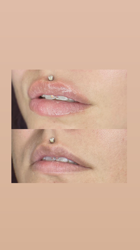 Lip Enhancement - Inital Session