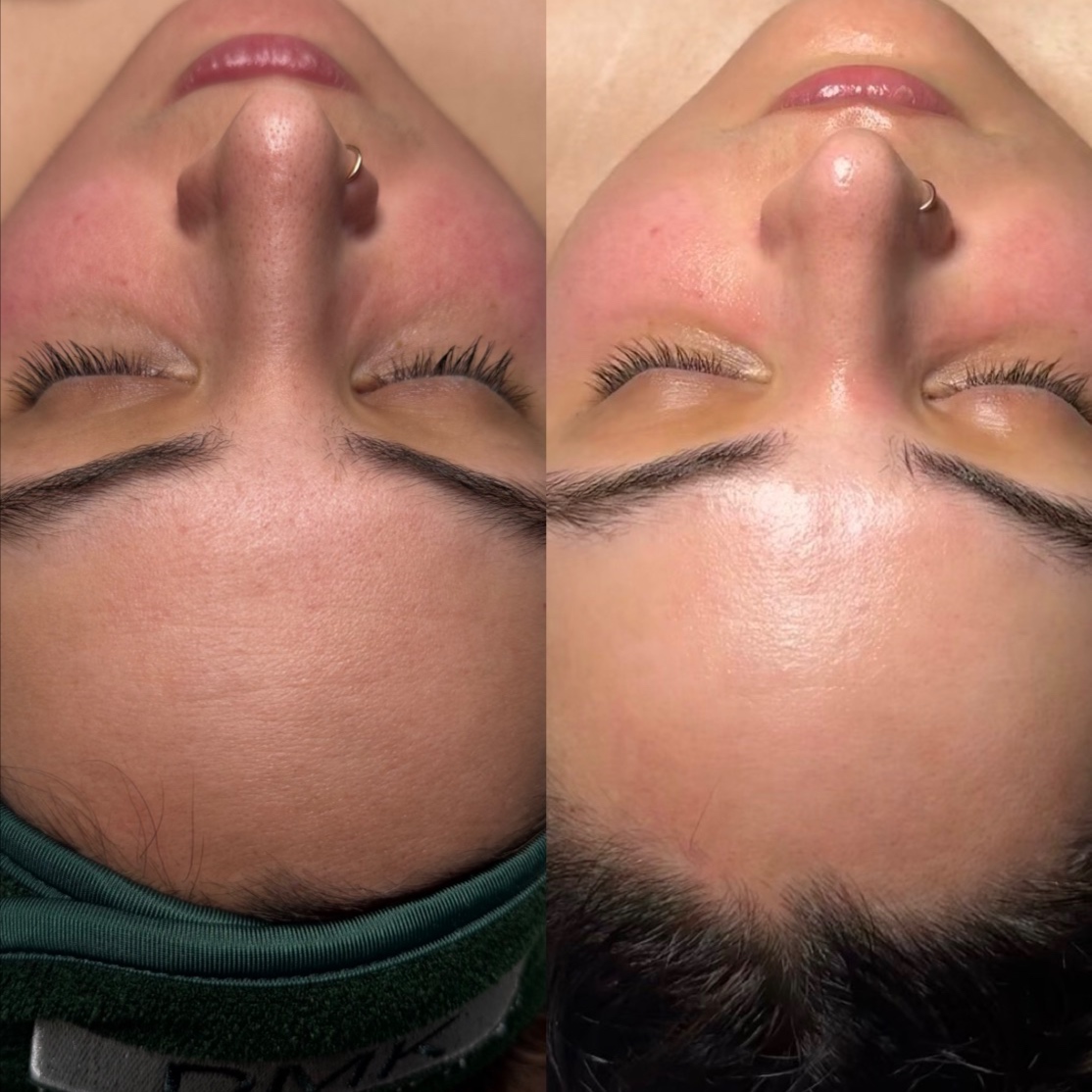 The Signature DMK Enzyme Treatment at Lyla Skin Studio in Aliso Viejo, CA