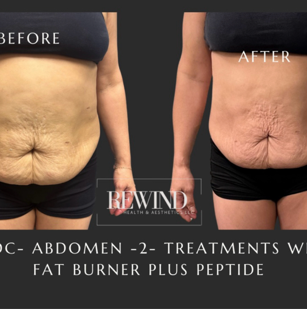 Abdominal & Love Handles PCDC đź’‰ at Rewind Health & Aesthetics LLC in San Marcos, TX