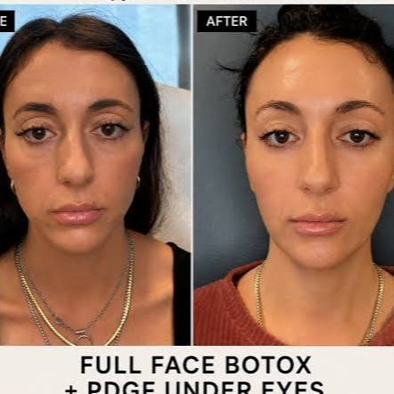 Wrinkle Treatment (Full Face) Tox at Ultimate Health Spa in Leesburg, FL