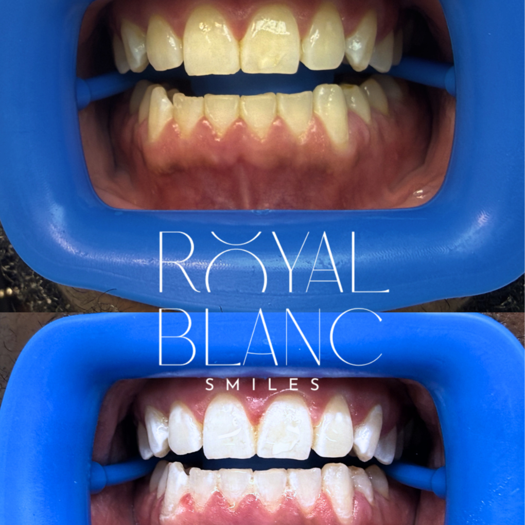 Extreme Teeth Whitening at Royal Blanc Smiles - Teeth Whitening and Tooth Gems in Charlotte, NC in Charlotte, NC