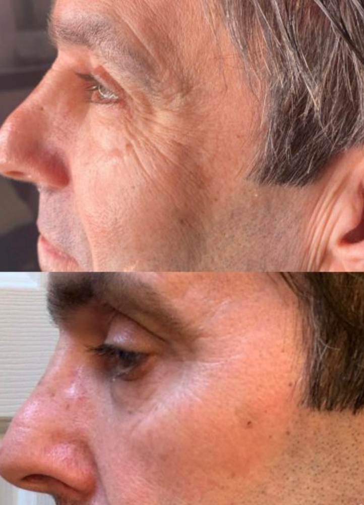 Eyelid Fibroblasting Treatment