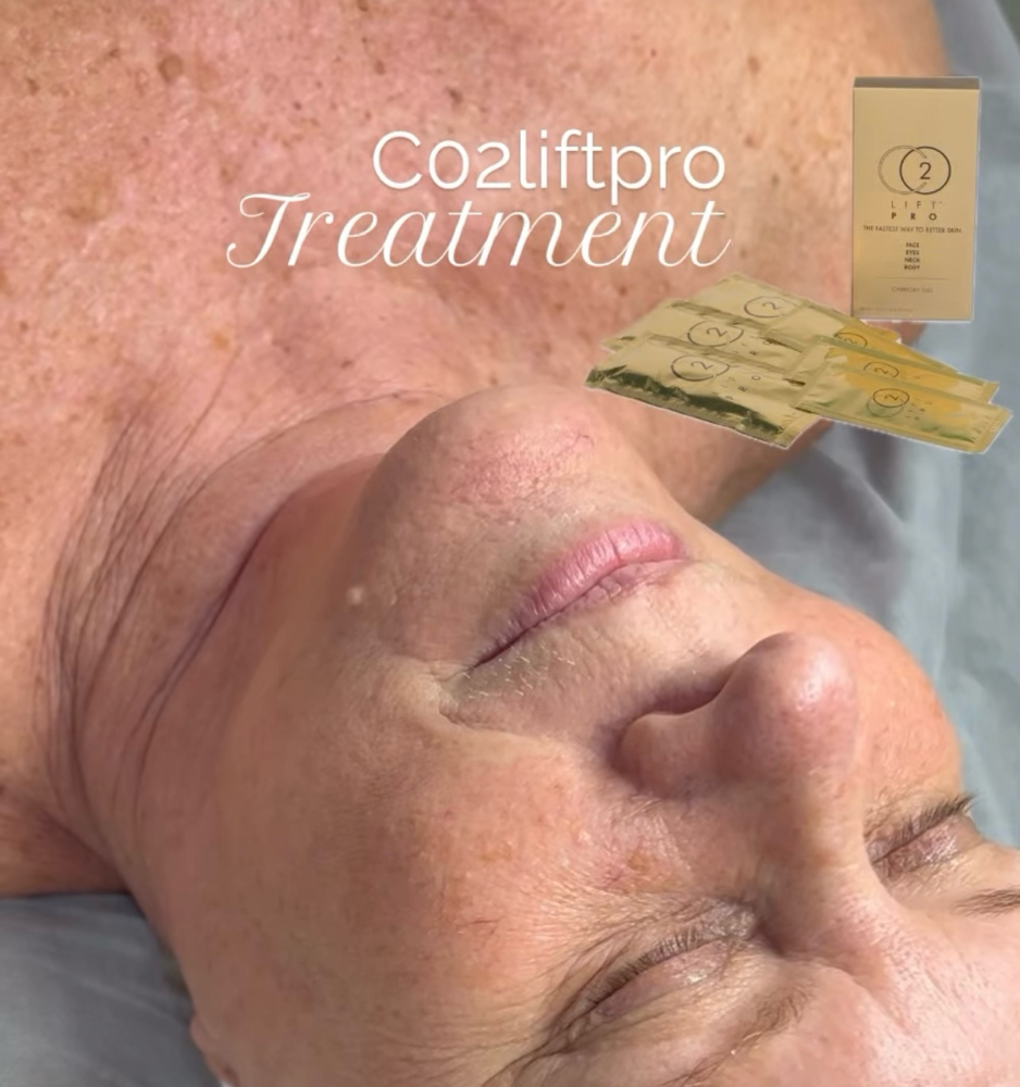 C02lift Pro treatment