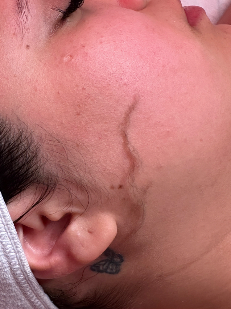 Dermaplane Facial