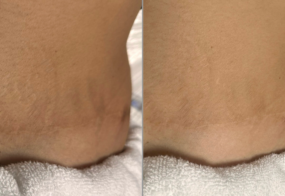 Hyperpigmentation Correction