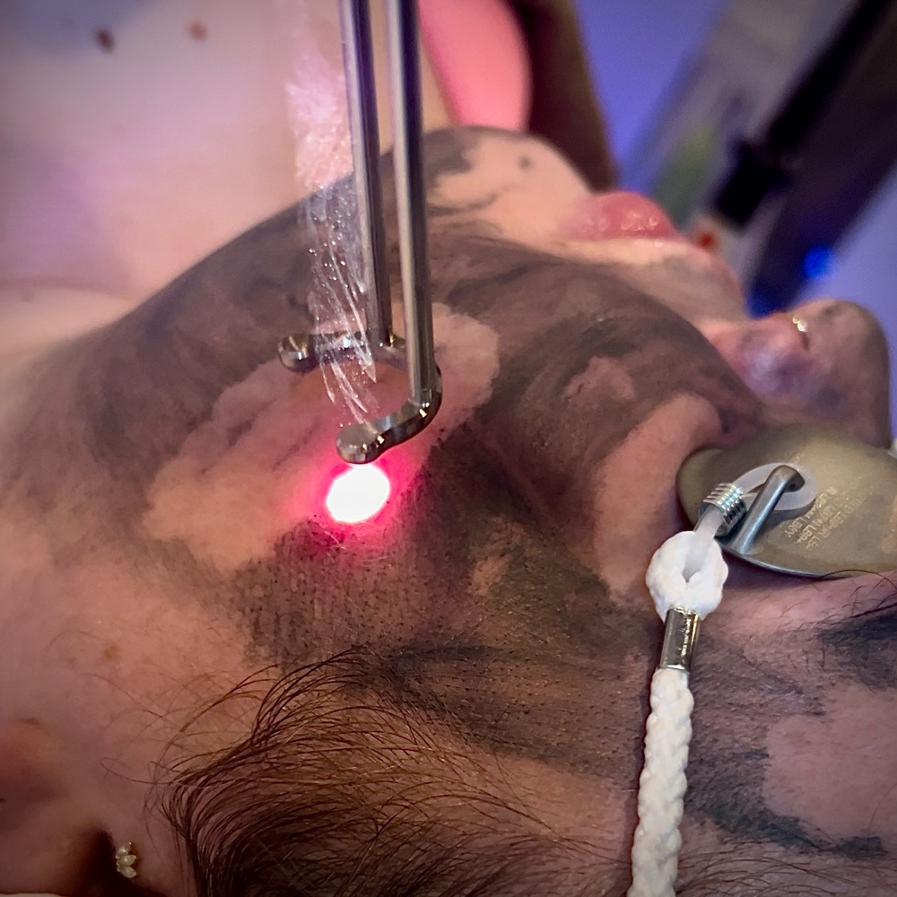 NaturaPeel Laser Treatment