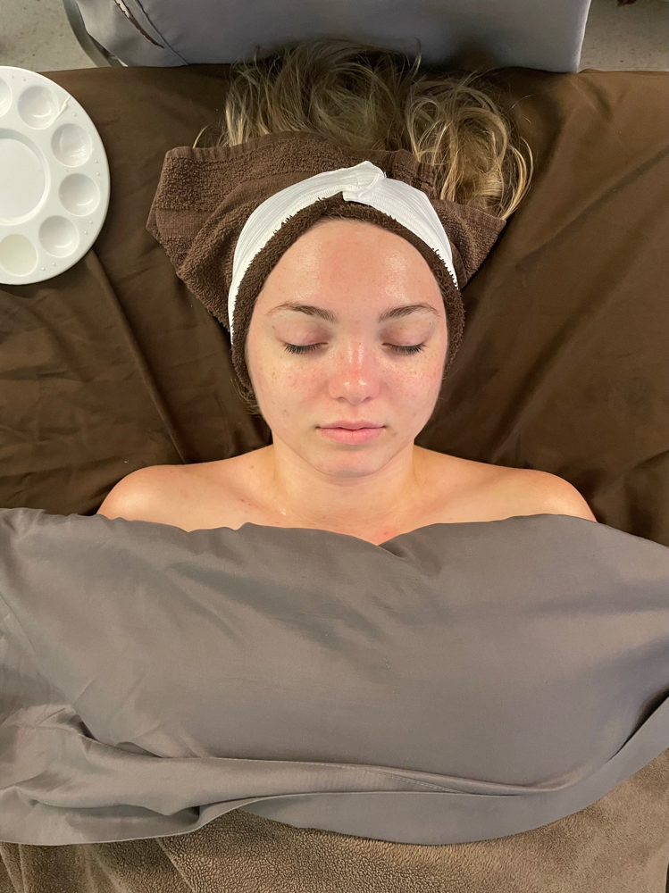 Chemical Peel