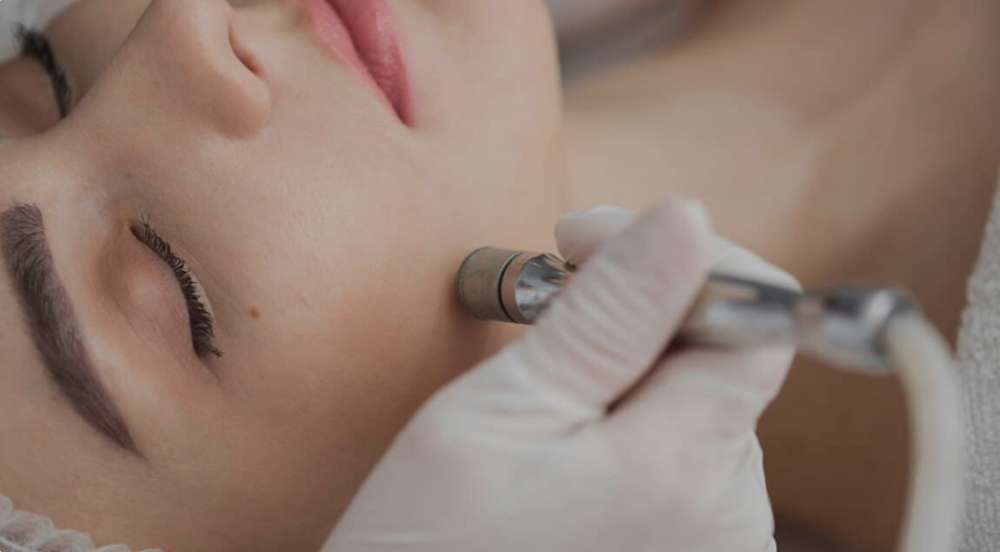 Diamond Microdermabrasion