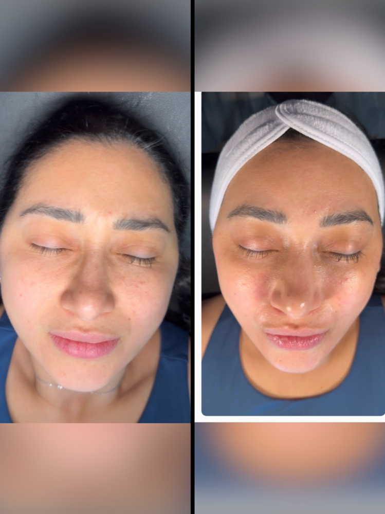 Summer Peel + Dermaplane