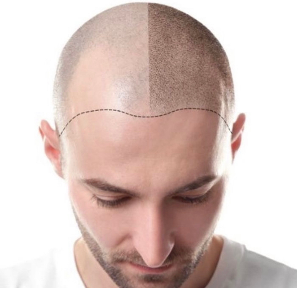 Scalp Micro Pigmentation