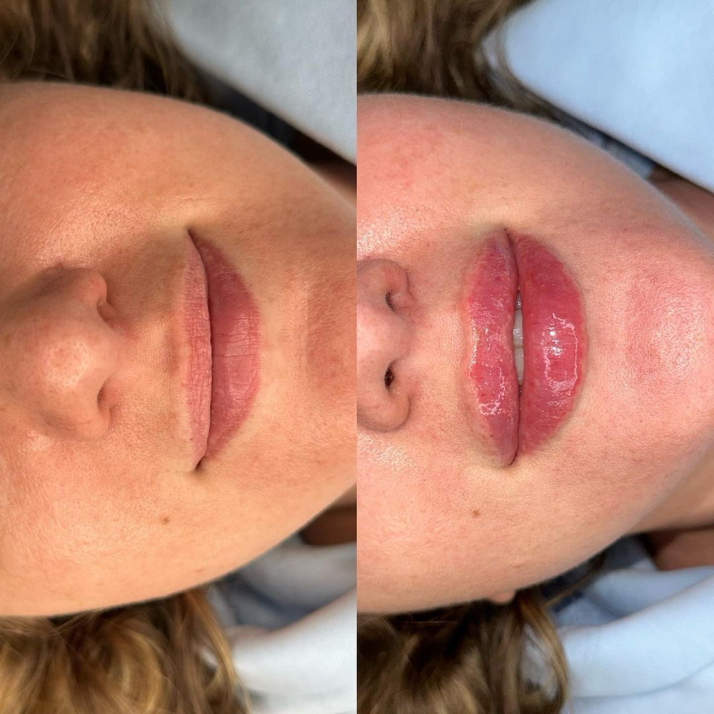 Hyaluronic Acid Lip Filler