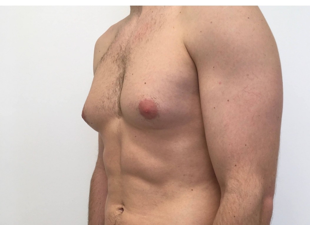 Reduction Of ManBoobs-Gynecomastia
