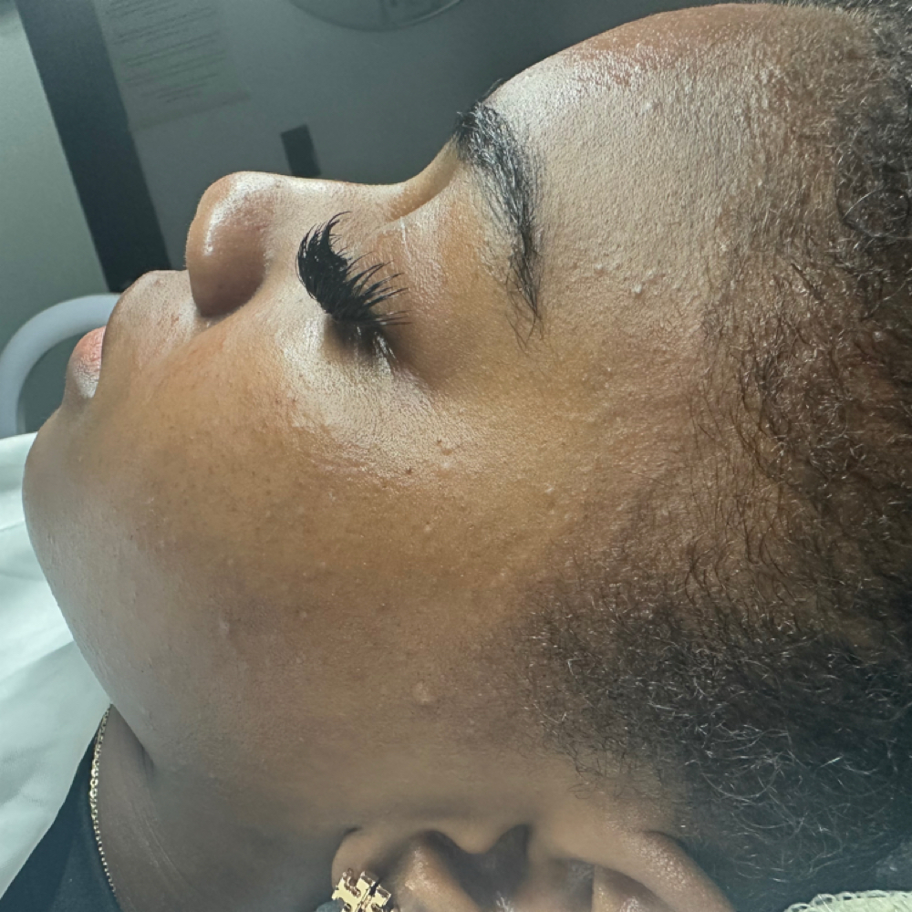 Acne Facials at Alluring Essence Skncare in Tampa Fl, FL