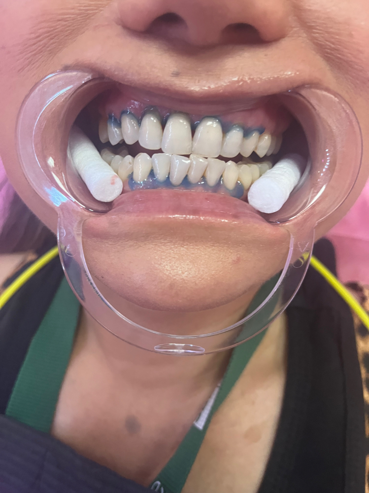 Teeth Whitening 40 Minutes