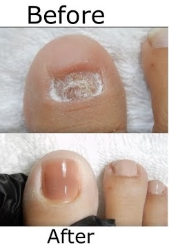 Toenail Reconstruction