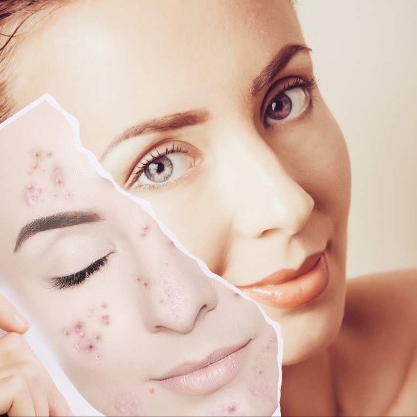 Acne Correction Facial at Tiffany Nails and Spa in Chantilly, VA