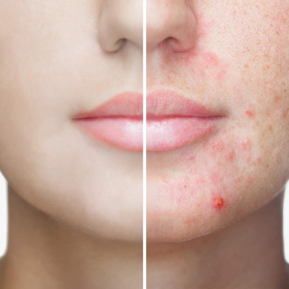Teen Acne Facial at Glow Beauty Lounge in New Concord, OH