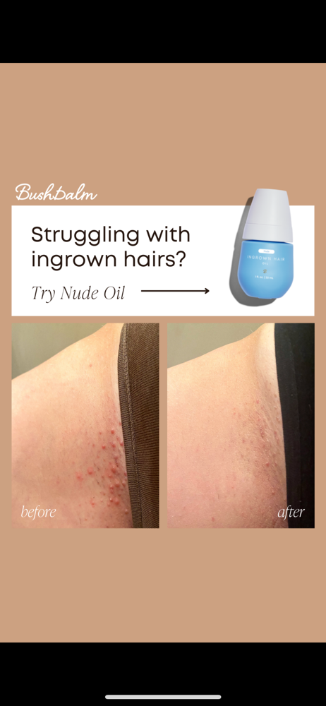Ingrown treatment Travel