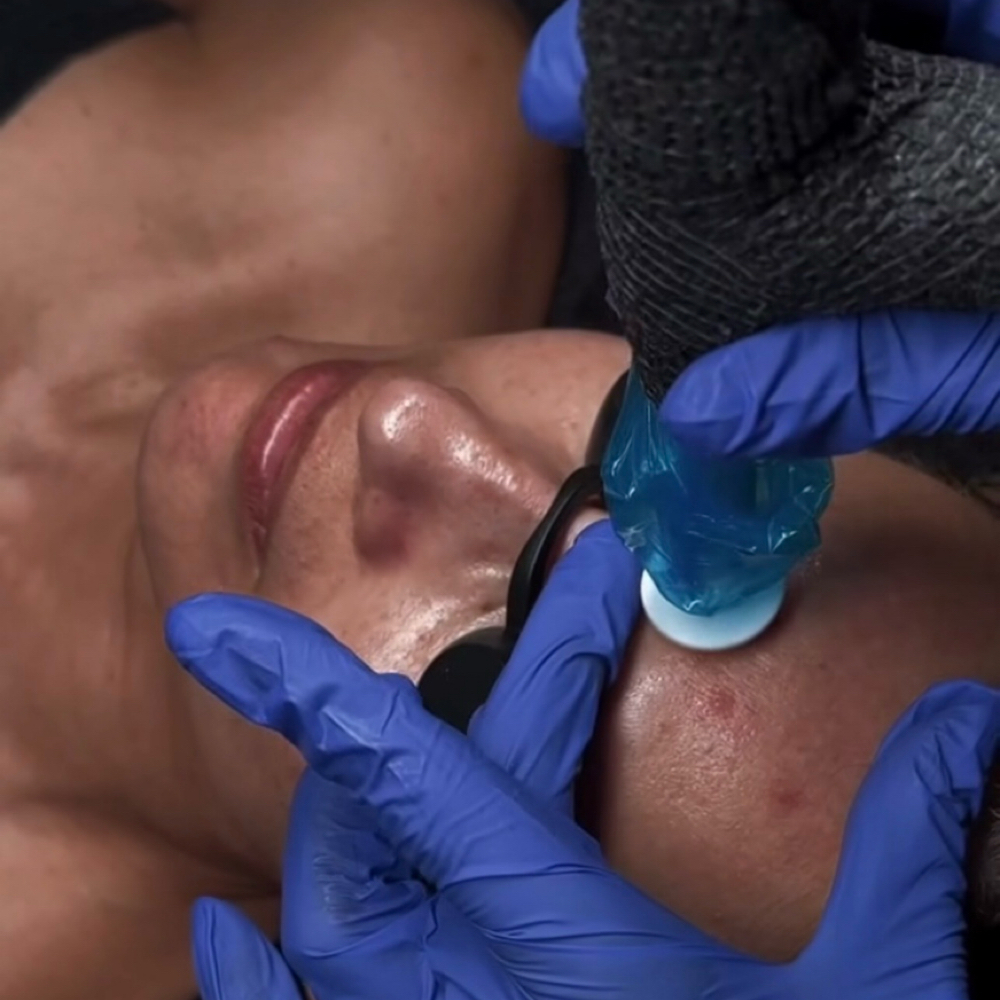 Procell Microchanneling at The Skin Suite 828 in Waynesville, NC