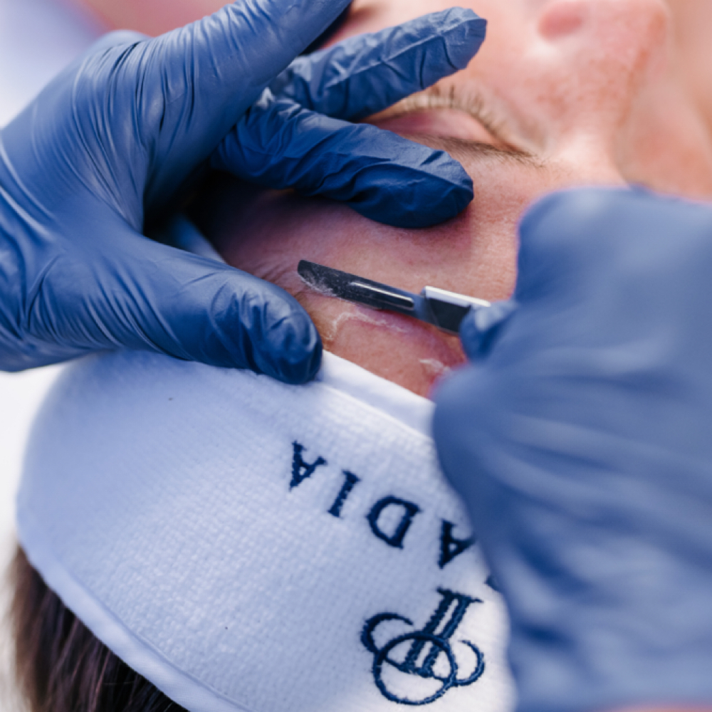 Dermaplaning Treatment at Milana Luxe Skin & Wellness in East Brunswick, NJ