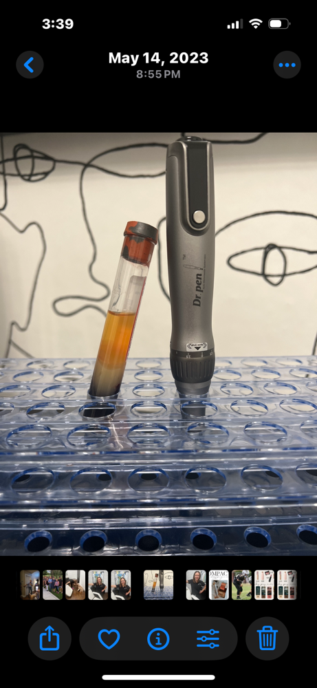 Platelet Rich Plasma Microneedling