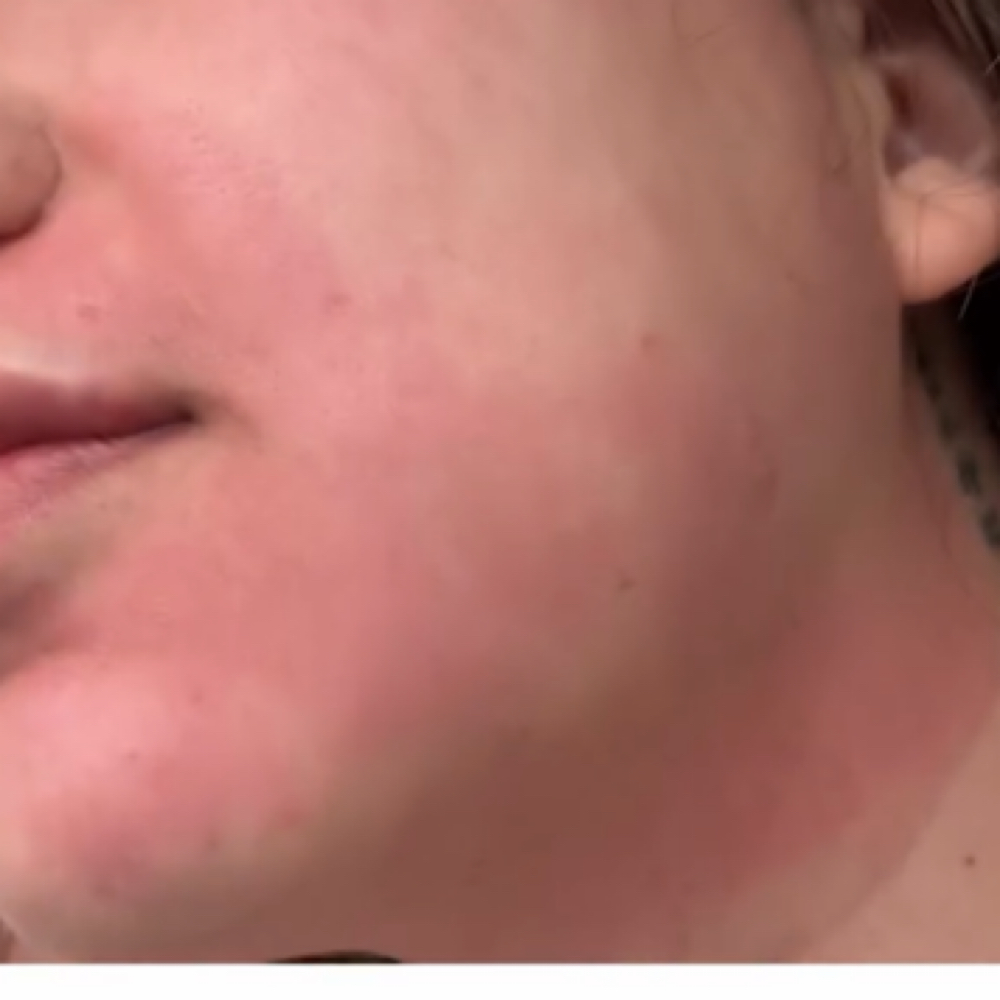 Collagen Induction Therapy at Eres Bella Day Spa in Bell, CA
