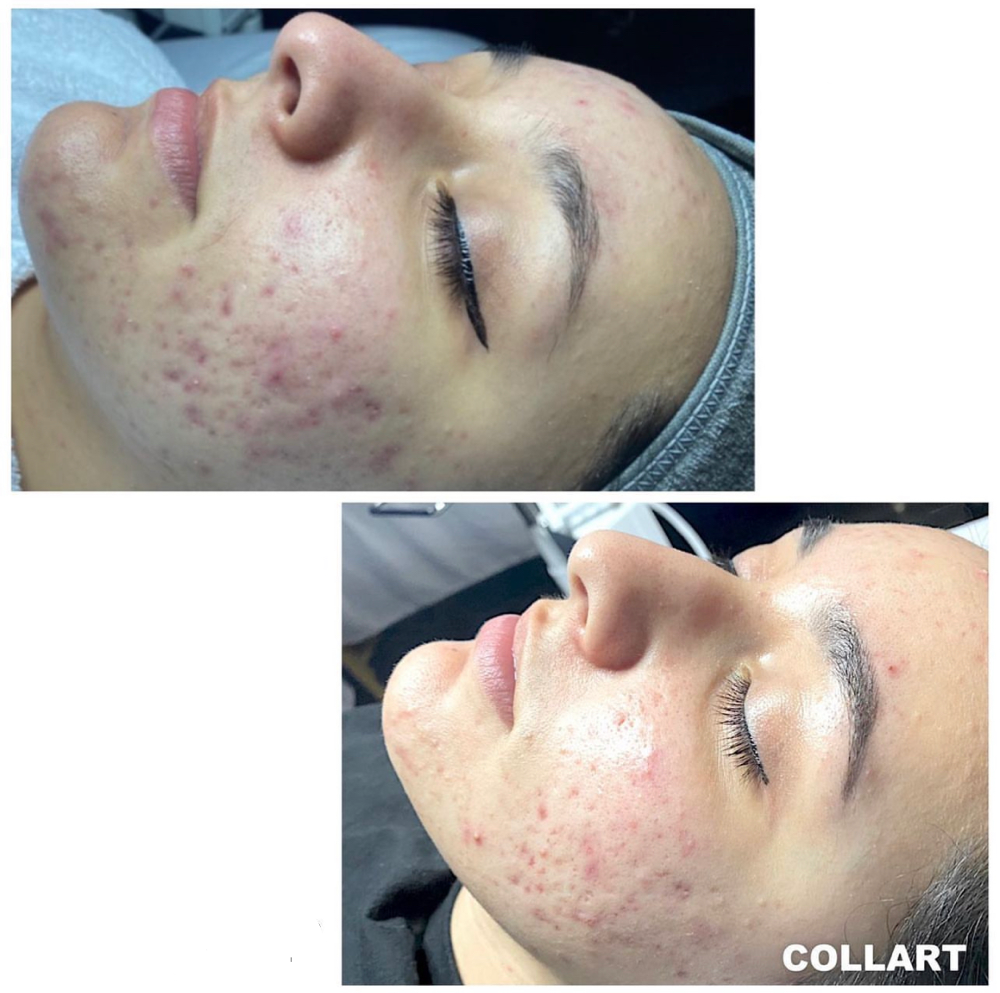 Acne Facial