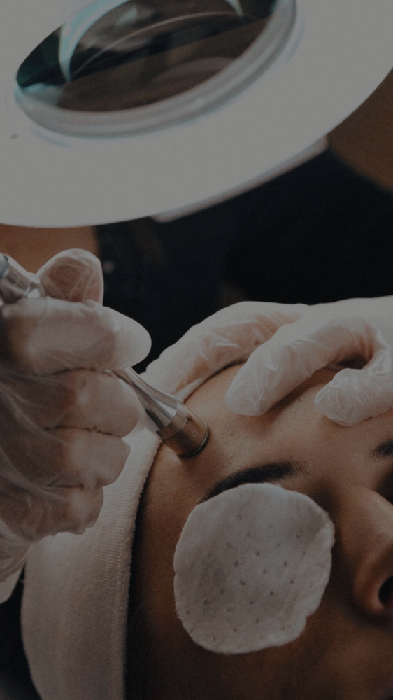 Microdermabrasion