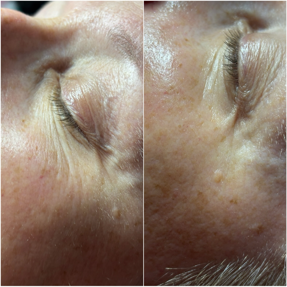 Eye Lift Treatment at Studio 4.22 in Palestine, IL