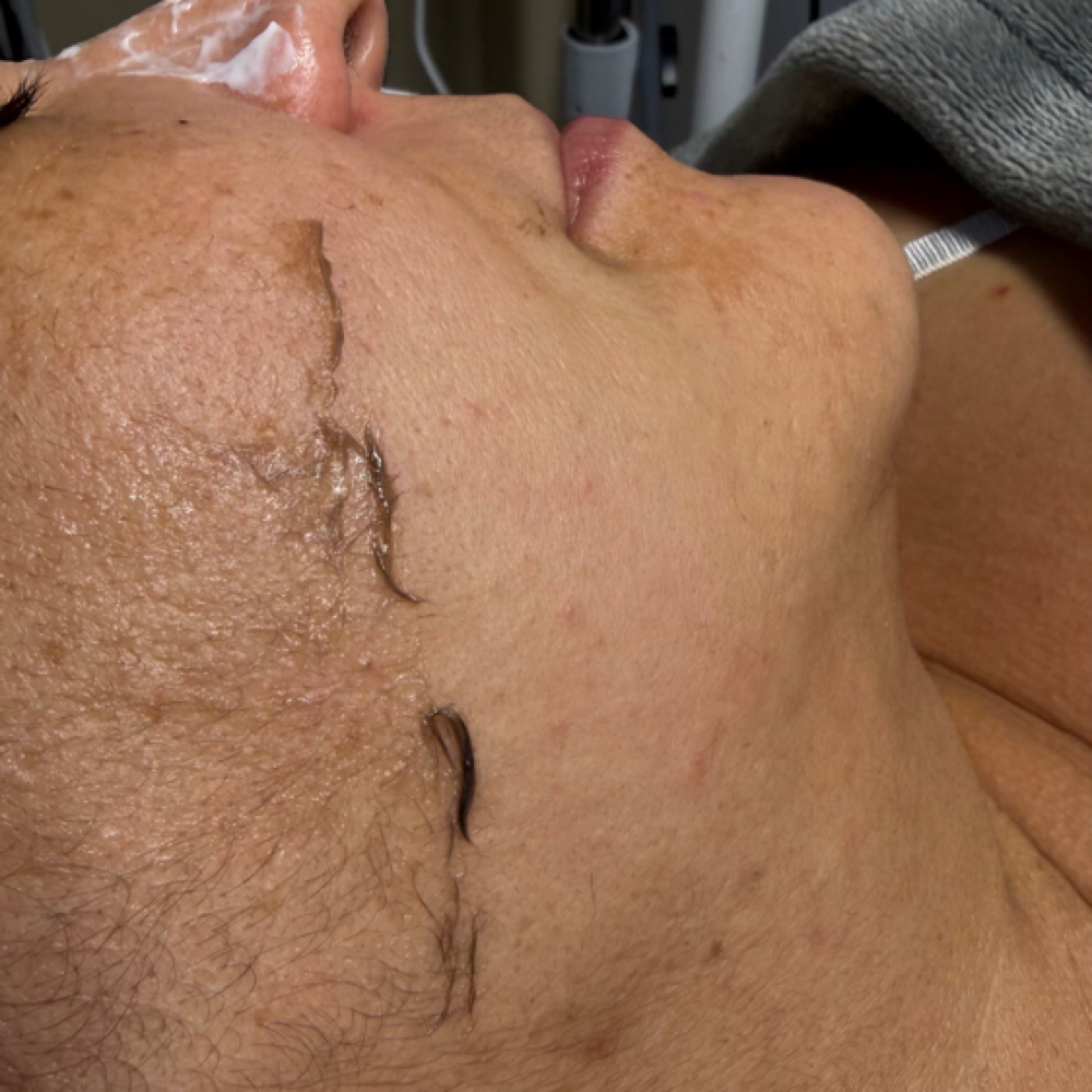 Dermaplaning at Any Beauty Aesthetics Care in New York, NY