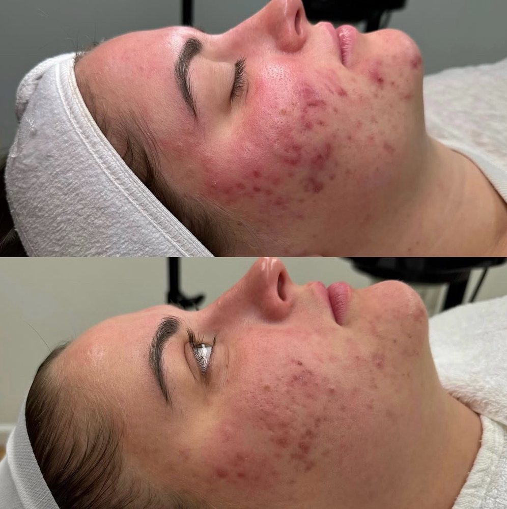 Clear Skin Consultation + Peel at Salt Skin Studio in Bentonville, AR