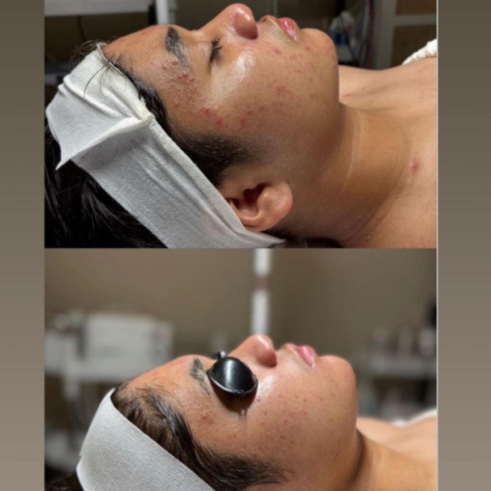 Acne Clearing Facial (90 min) at Project360 Aesthetics in Pearland, TX