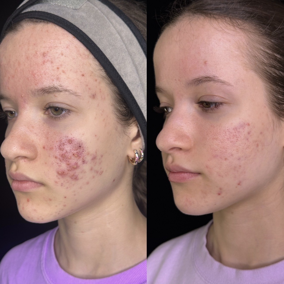 Laser genesis | acne treatment at Corrective treatments + professional skincare in Atlanta, GA