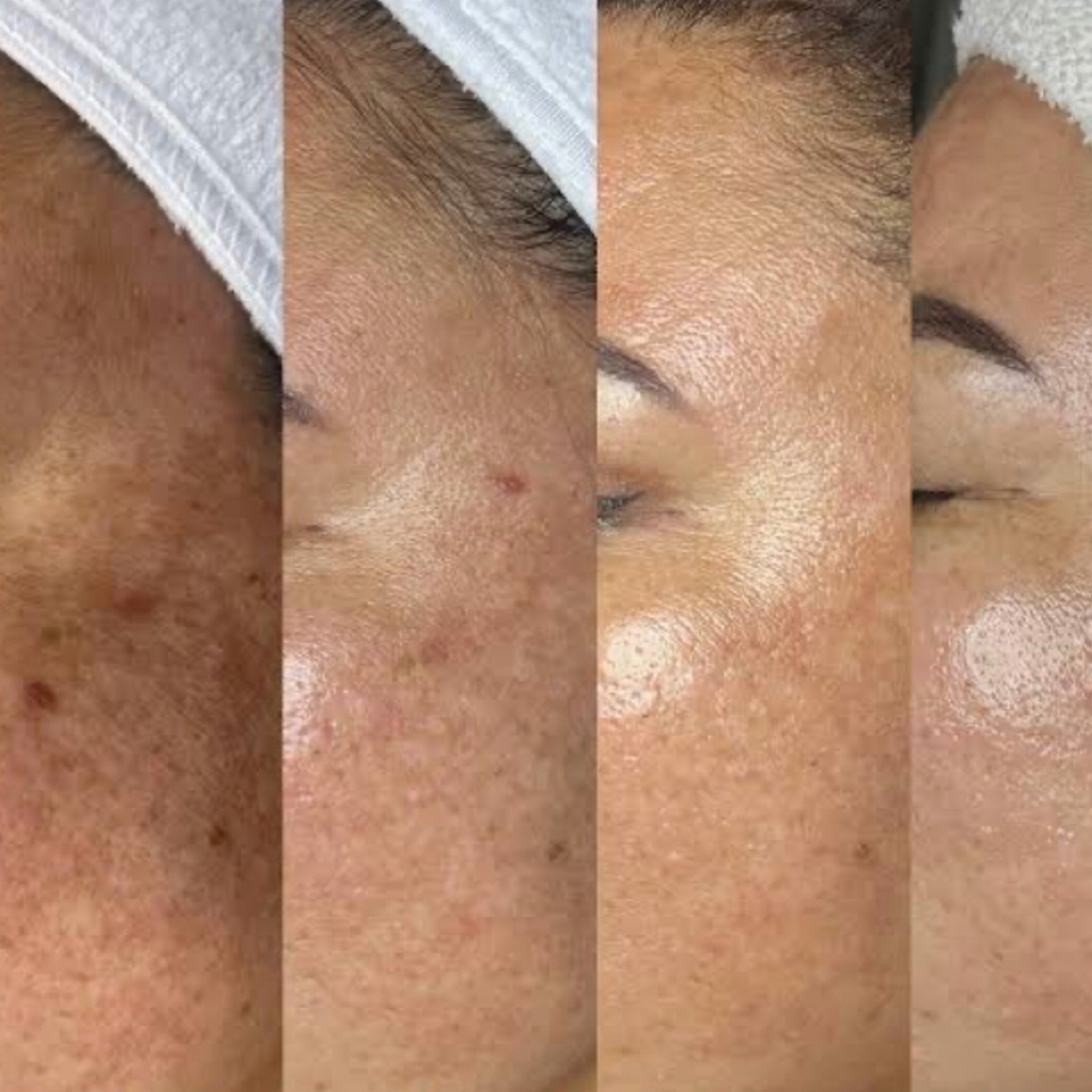 Melasma Chemical Peel at Angel Aesthetics in Jacksonville, FL