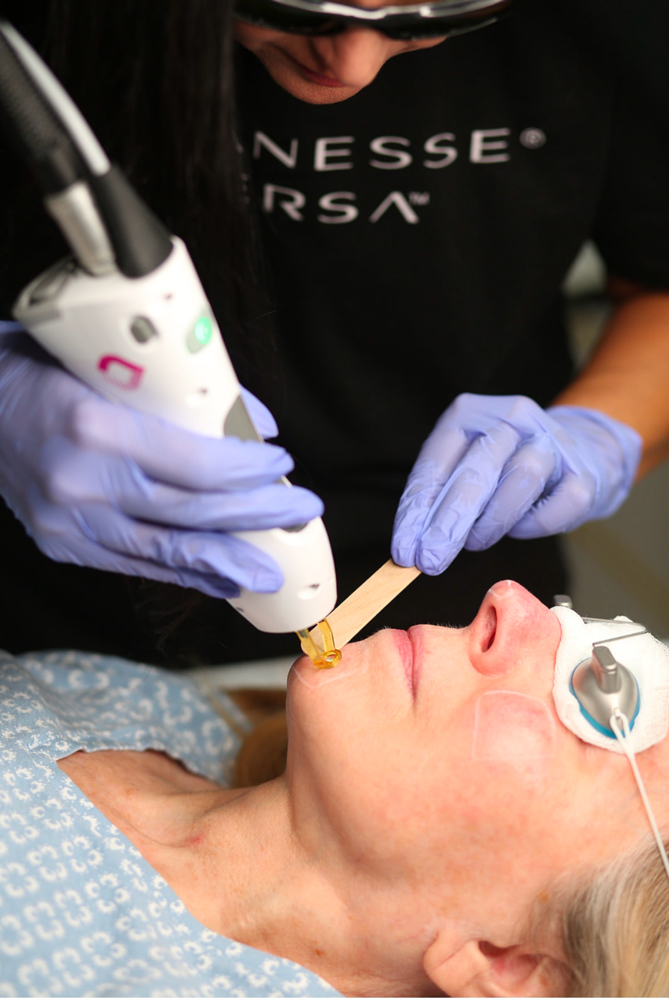 Laser Tx For Facial Spider Veins