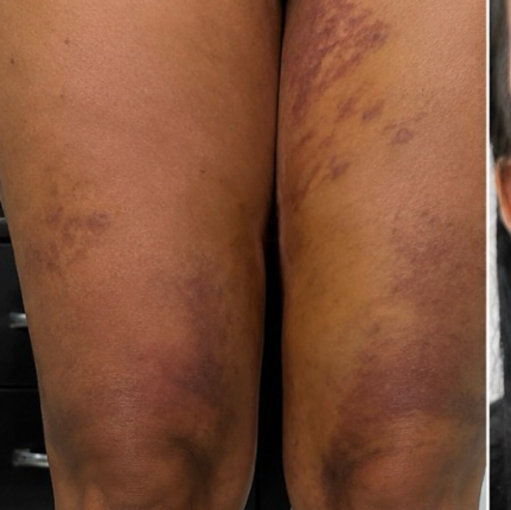 Thigh Post-Op Recovery at Healing Touch by Tasha in Tarzana, CA
