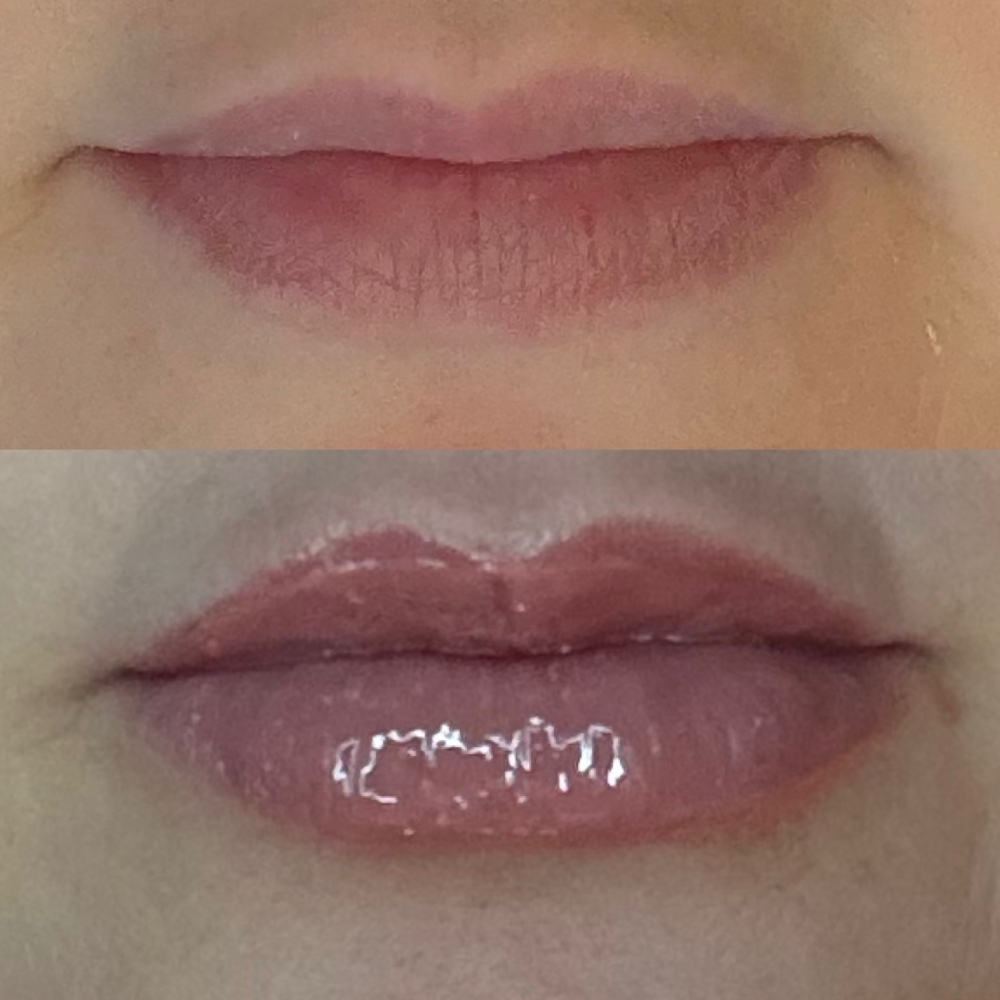 Lip Filler Full Syringe at Candice Stacy in Gilbert, WV