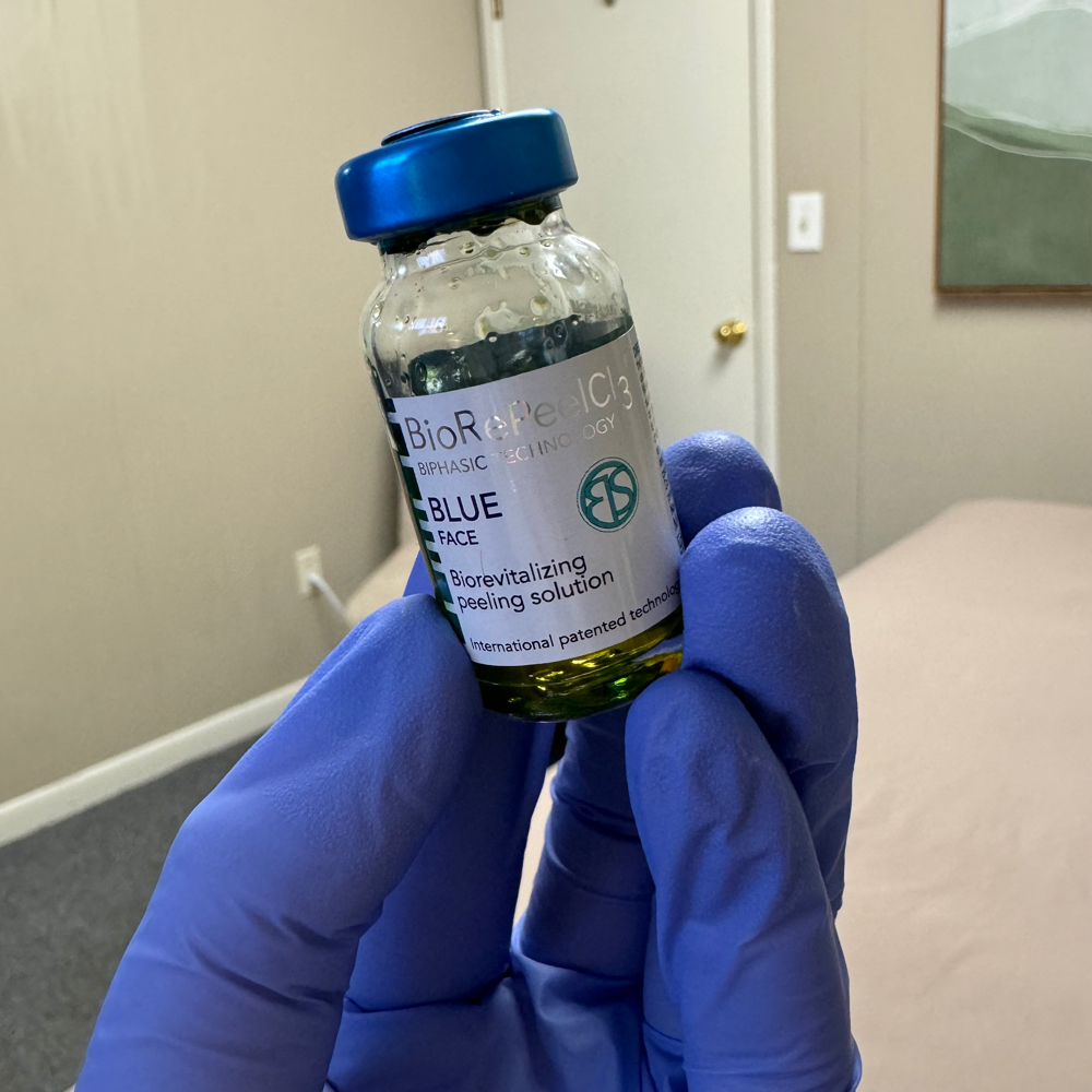 Chemical Peel