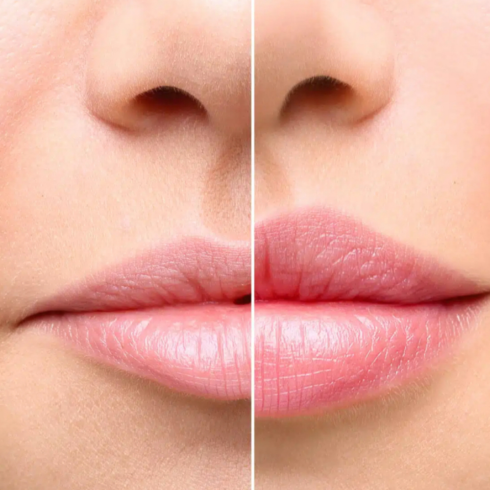 Lip Filler at Be Radiant Medical Spa in Muskego, WI