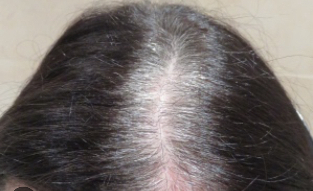 Above Shoulder Gray Coverage