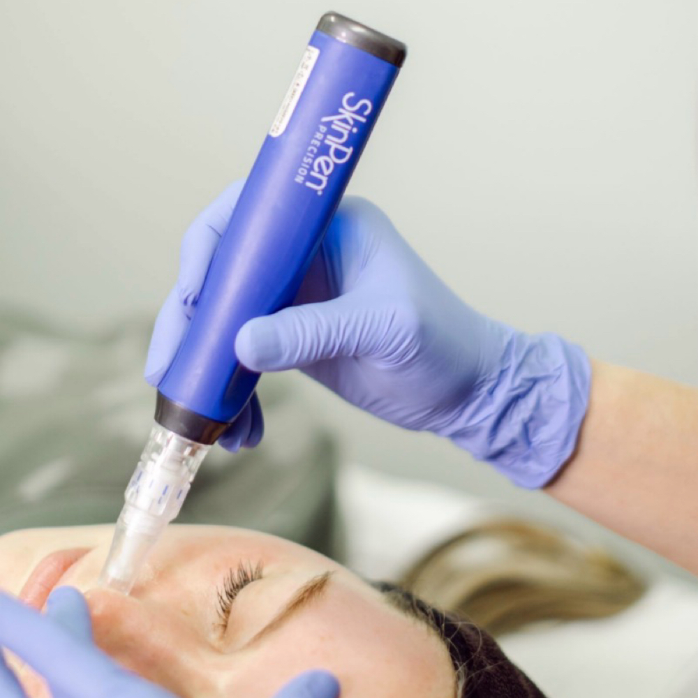 SkinPen Microneedling at Alira Aesthetics in Mcallen, TX
