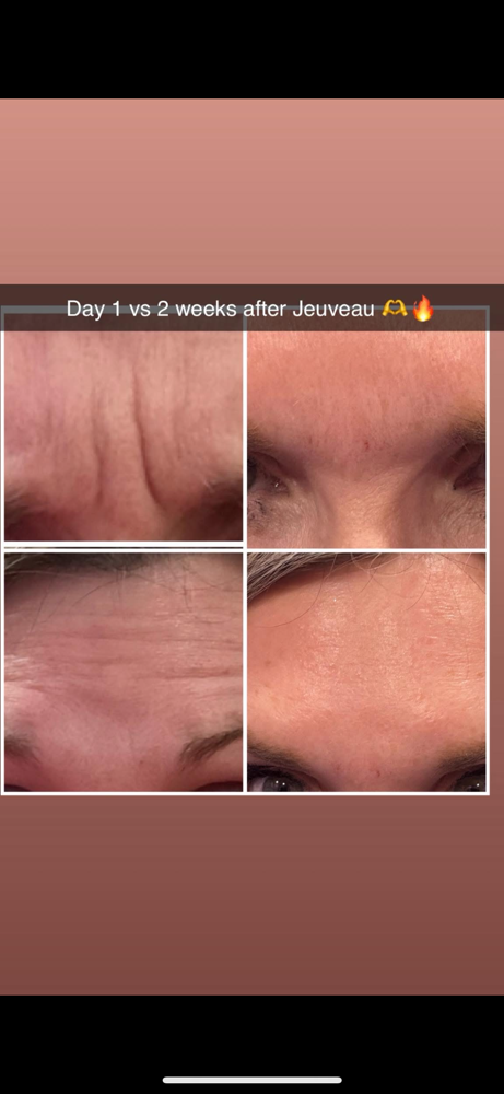 Jeuveau (neurotoxin) $11/unit