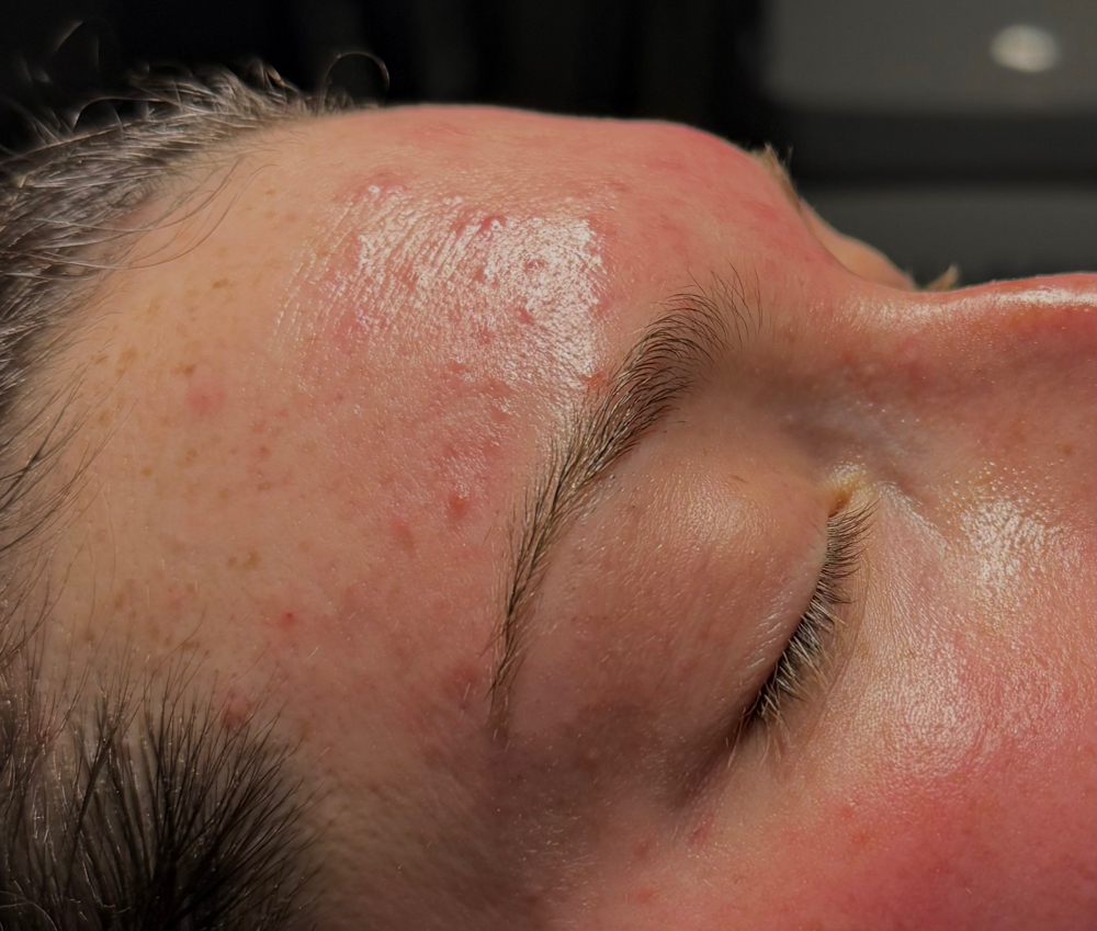 Acne Facial at MadSkin Esthetics in Colorado Springs, CO