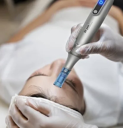 Microchanneling Facial at Graceful A Beauty in Anna, TX