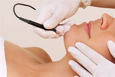 Electrolysis Consultation