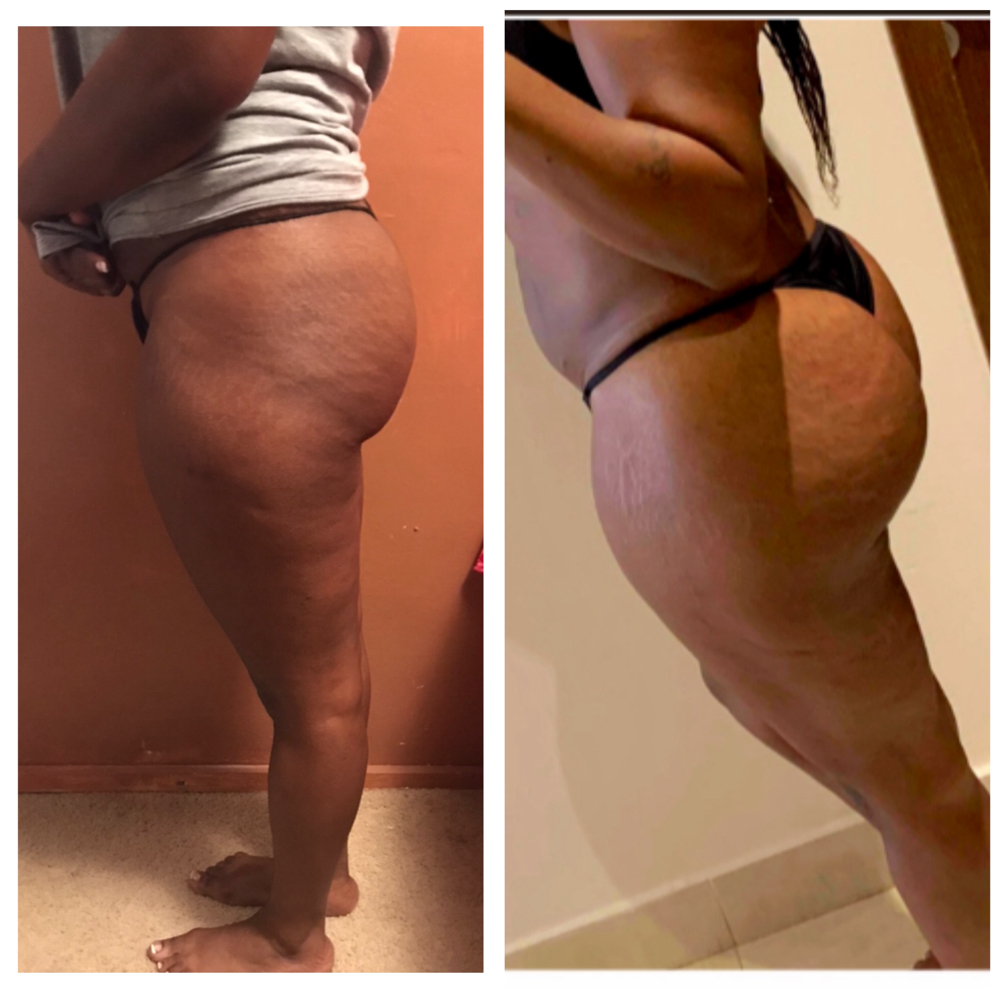 Deluxe Butt Injections (Suction Cups & Butt Injections)