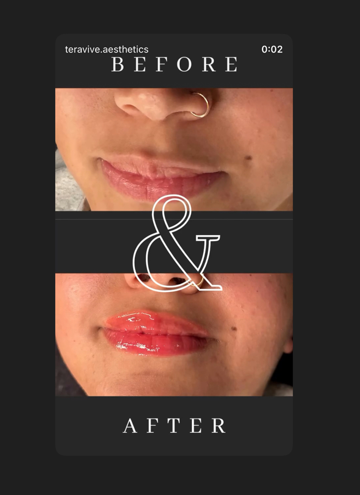 Hydro lips ( Lip Rejuvination)
