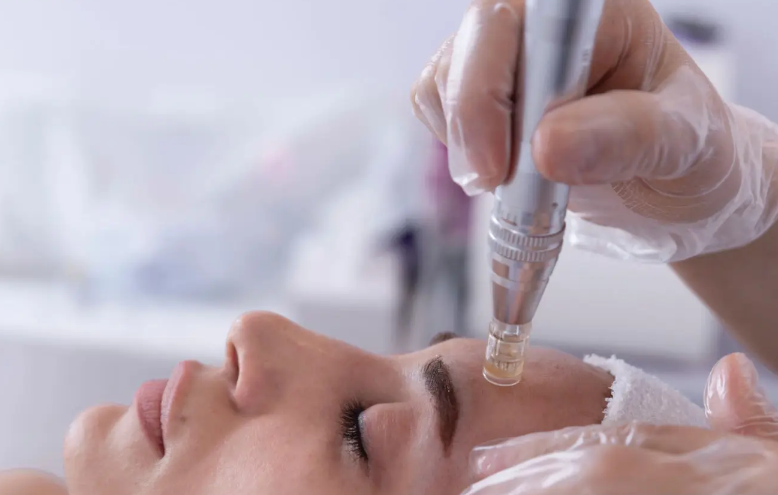 Microneedling