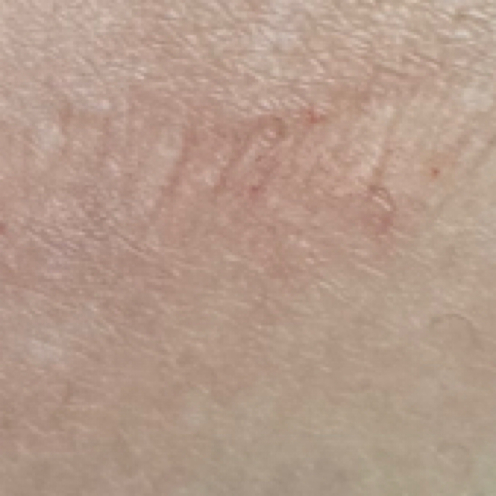 Stretch Mark Blending at Ink Theory Aesthetics in New Braunfels, TX